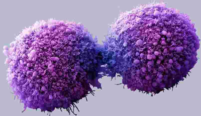 Nueva cura potencial del cáncer de páncreas mediante “células asesinas”, incluso con metástasis