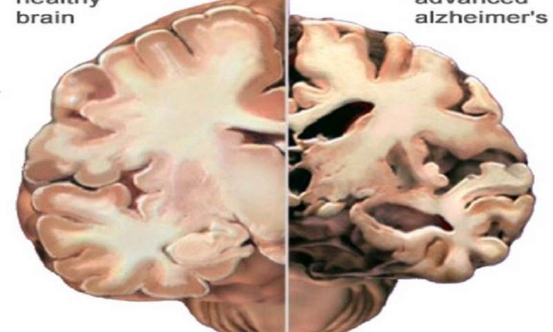 Disminución del sueño profundo relacionado con signos tempranos de la enfermedad de Alzheimer
