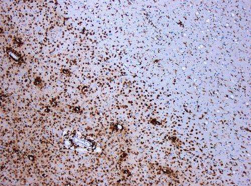 Nuevas pistas sobre el origen y progresión de la esclerosis múltiple