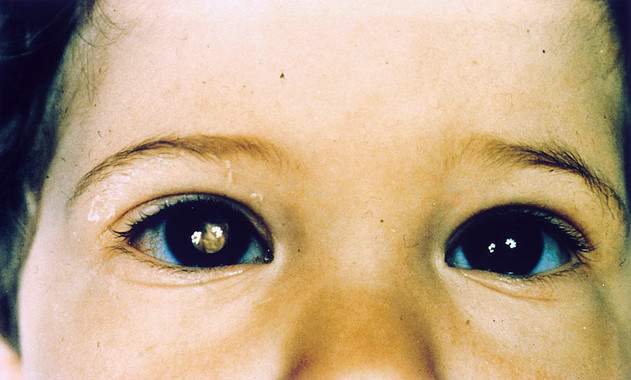 Un fármaco biológico para tratar el cáncer de retina en niños