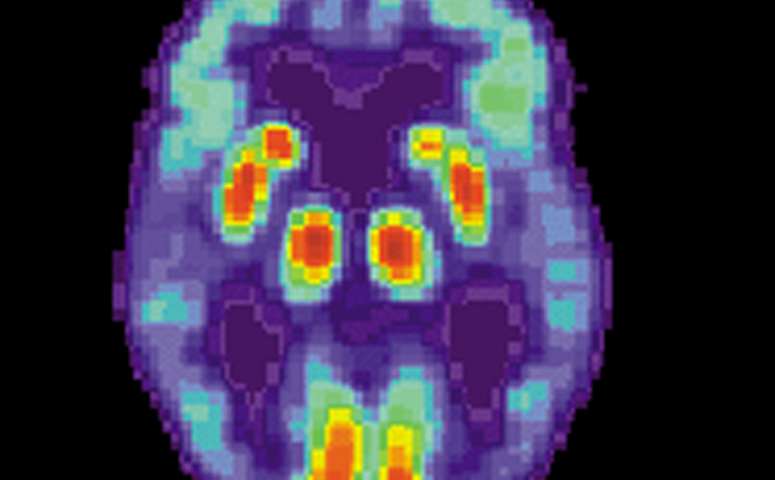 Un nuevo culpable de deterioro cognitivo en la enfermedad de Alzheimer