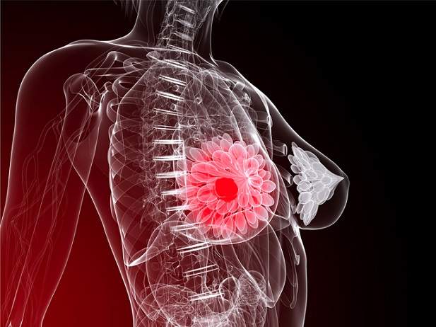 Un modelo estadístico anticipa el riesgo de recaída en cáncer de mama