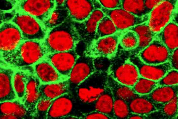 Nanopartículas de oro tiñen la orina en presencia de un tumor colorrectal
