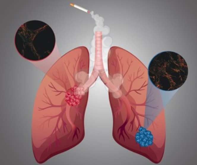 Nuevo adelanto en la mejora del tratamiento del cáncer de pulmón avanzado