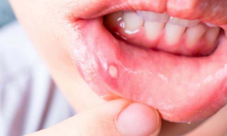 Descubren por la que las heridas en la boca se curan más rápido que en la piel
