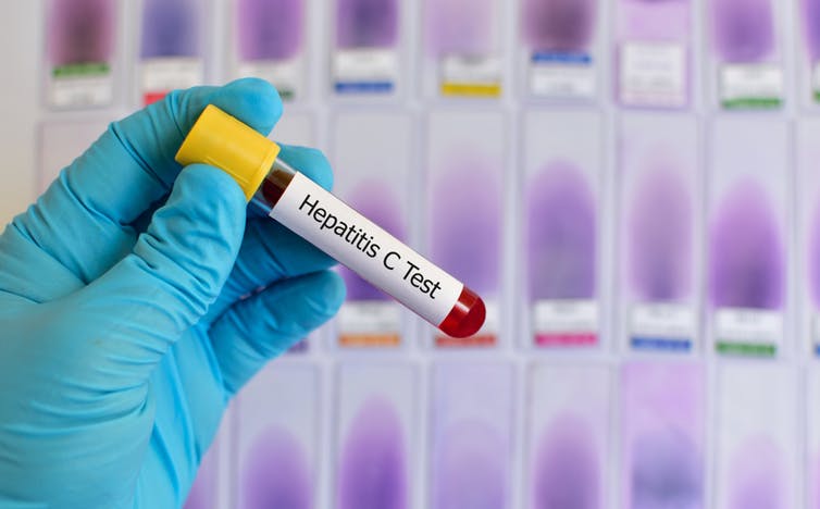 La lucha contra la hepatitis C: por qué es un caso de éxito ejemplar