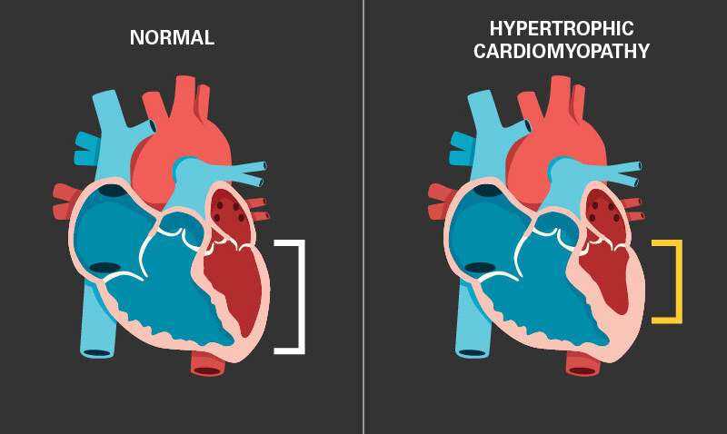 Un cambio de corazón: un nuevo fármaco para la MCH reduce la masa cardíaca