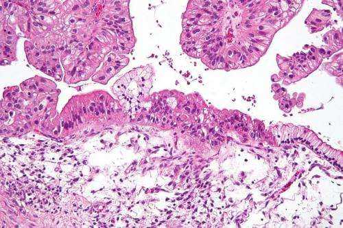 Las células de cáncer de ovario cooperan para hacer metástasis