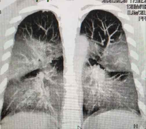 Especialistas en altura bolivianos explican la destrucción pulmonar causada por COVID-19