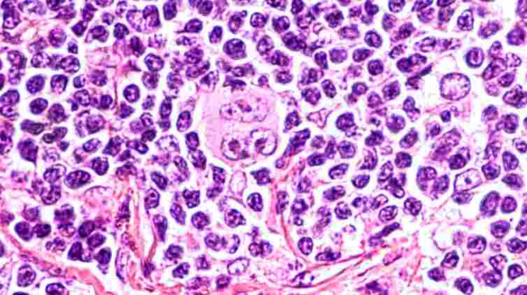 El extraño caso de la curación de un linfoma de Hodgkin por el SARS-CoV-2