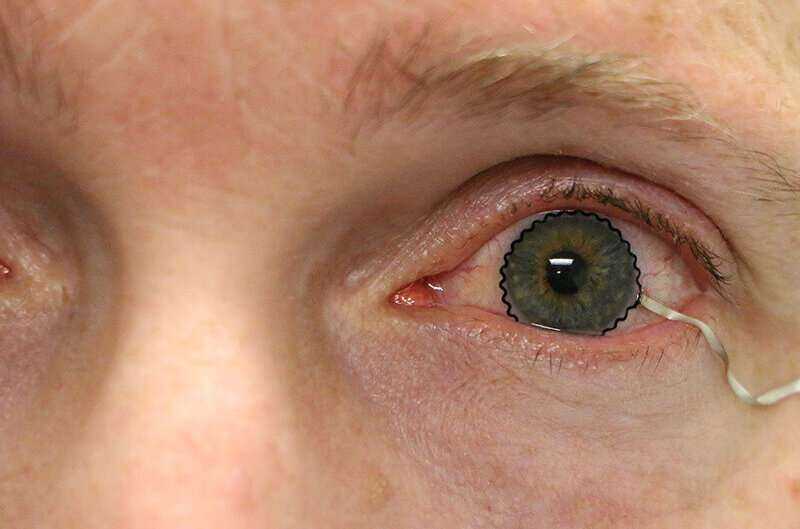 Lentes de contacto blandas como nuevas soluciones para el seguimiento de enfermedades oculares