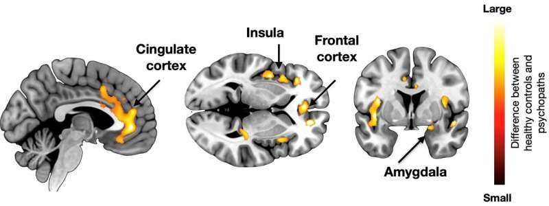Un nuevo estudio revela la base cerebral de la psicopatía