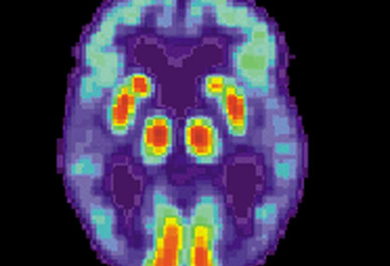 Los investigadores utilizan la inteligencia artificial para detectar los primeros signos de la enfermedad de Alzheimer
