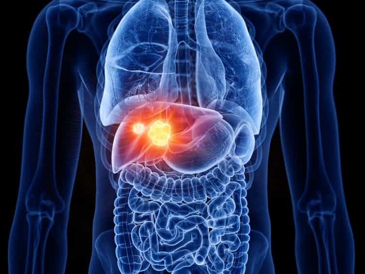 ¿Cómo saber qué personas con hígado graso tienen mayor riesgo de padecer cáncer hepático?