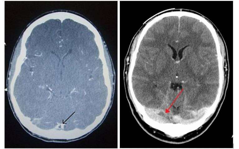 Tratamiento de casos raros de coagulación sanguínea en el cerebro después de la vacunación COVID-19