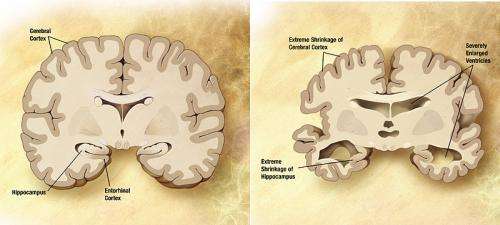Un nuevo estudio identifica la causa probable de la enfermedad de Alzheimer