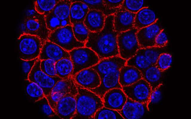 Se descubre el vínculo entre la inflamación y el desarrollo del cáncer de páncreas