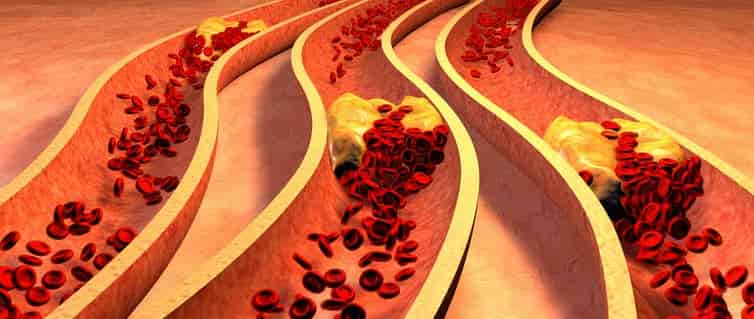 Cómo la obesidad daña los vasos sanguíneos