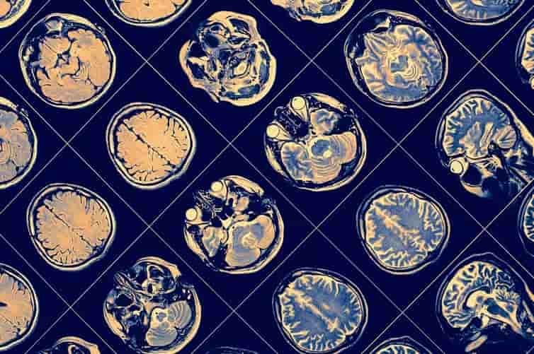 Las seis razones por las que cuesta tanto encontrar una cura para el alzhéimer