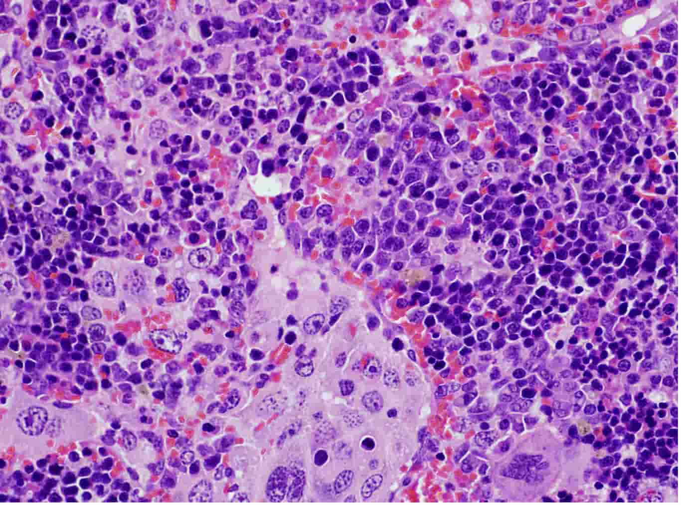 Revelada una mutación genética clave en la aparición de linfomas y el cáncer de pulmón