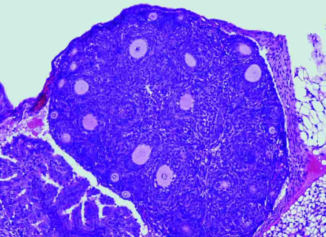 La mutación de un solo gen desencadena el desarrollo de un tipo de cáncer de ovario