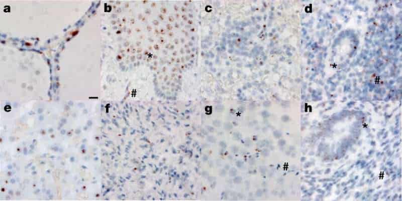 Las autopsias muestran el virus COVID-19 en el cerebro, en otras partes del cuerpo