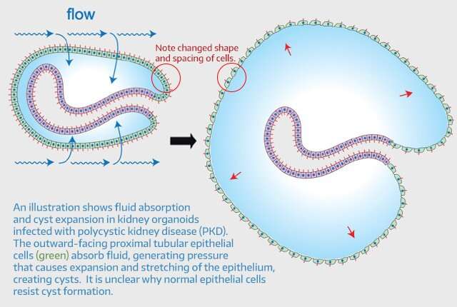 Estudio ilumina el papel del azúcar en la enfermedad renal común