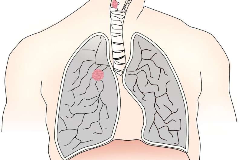 ¿Comer mejor y respirar mejor? Una investigación apunta a una relación entre la dieta y el cáncer de pulmón.