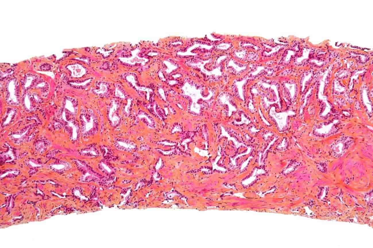 La transformación de grasa blanca en parda puede ser beneficiosa para la prevención del cáncer de próstata