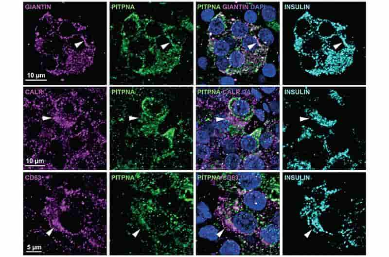 Un estudio de células beta arroja luz sobre la causa de la diabetes tipo 2