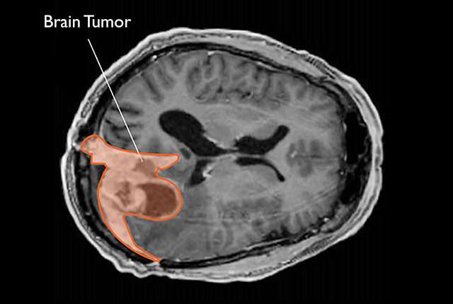 El uso prolongado de ciertos medicamentos hormonales está relacionado con un mayor riesgo de tumor cerebral