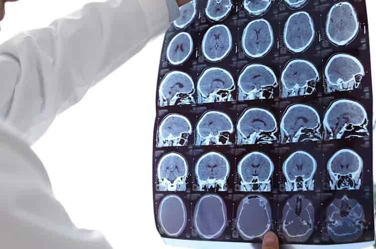 Un prometedor avance español para tratar enfermedades neurodegenerativas