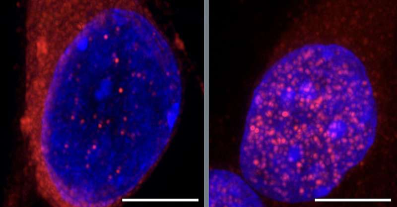 Identificada una vía clave que conduce a la neurodegeneración en las primeras etapas de la ELA