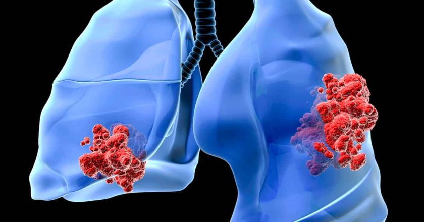 El rendimiento en pruebas físicas puede ayudar a orientar el tratamiento del cáncer de pulmón