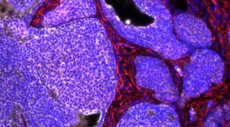 Un nuevo compuesto reduce en ratones la metástasis en cáncer de mama