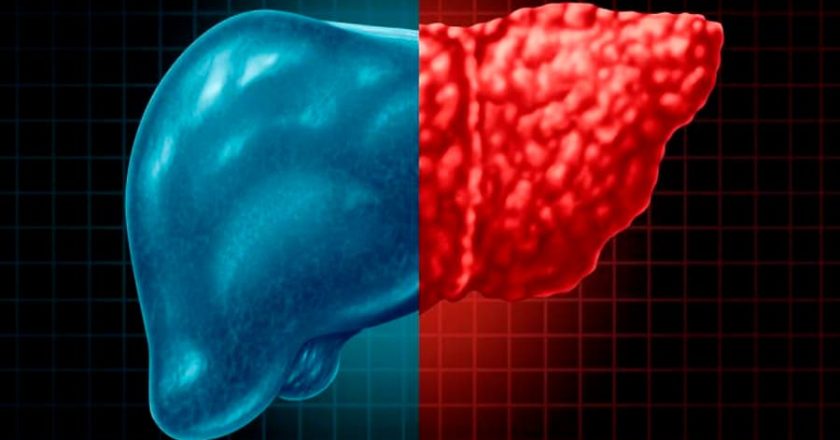 Un fármaco experimental mejora la diabetes tipo 2 y el hígado graso