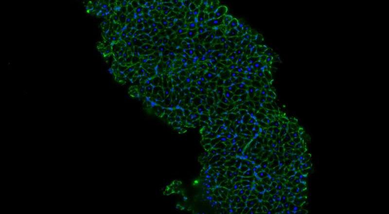 No todas las inflamaciones cardíacas son iguales: un estudio identifica firmas inmunes únicas en casos de miocarditis