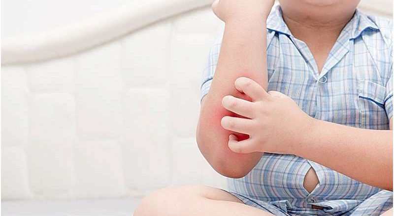 Los niños con obesidad tienen mayores tasas de enfermedades dermatológicas