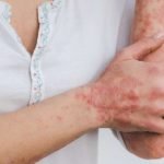Terapias biológicas de última generación para la psoriasis: qué viene en 2025