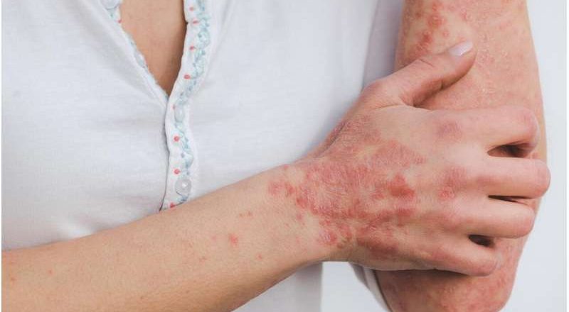 Una dieta rica en plantas y baja en grasas saturadas se asocia con una menor gravedad de la psoriasis