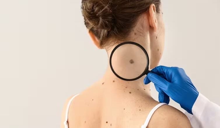 El melanoma: un cáncer duro de pelar