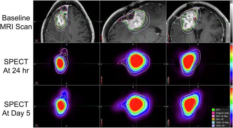 Descubren fármaco experimental que duplica el tiempo de supervivencia de pacientes con glioblastoma