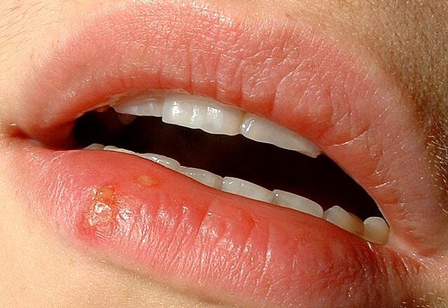 El descubrimiento del herpes labial identifica un desencadenante desconocido para esos molestos brotes