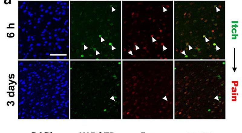 Cómo el cerebro distingue entre dolor y picazón