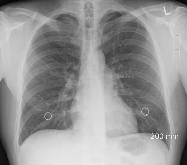 Inmunoterapia combinada en cáncer de pulmón: realidades y retos en 2025