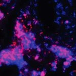 Un fármaco experimental contra el cáncer podría agilizar el tratamiento estándar de la tuberculosis y prevenir la enfermedad pulmonar posterior a la tuberculosis.