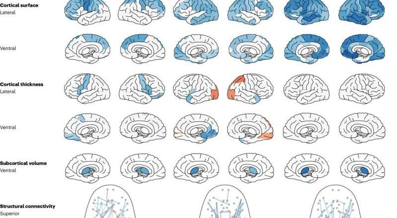 Una nueva investigación traza similitudes y diferencias entre el insomnio, la ansiedad y la depresión