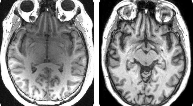 La IA puede acelerar la búsqueda de medicamentos más eficaces contra el Alzheimer al agilizar los ensayos clínicos