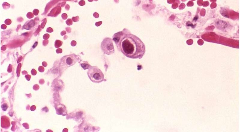 Cómo un virus común del herpes evade el sistema inmunológico: un estudio aborda una de las principales causas de defectos de nacimiento