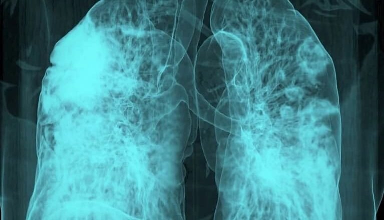 Las células cancerosas ‘dormidas’ en los pulmones pueden ser despertadas por la COVID y la gripe